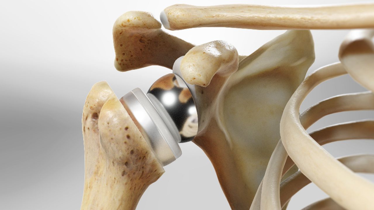 Shoulder replacement surgery involves replacing a damaged shoulder joint with an artificial one.